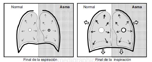 Vista De Fisiopatologia De Los Problemas Respiratorios En Pacientes Asmaticos Recimundo